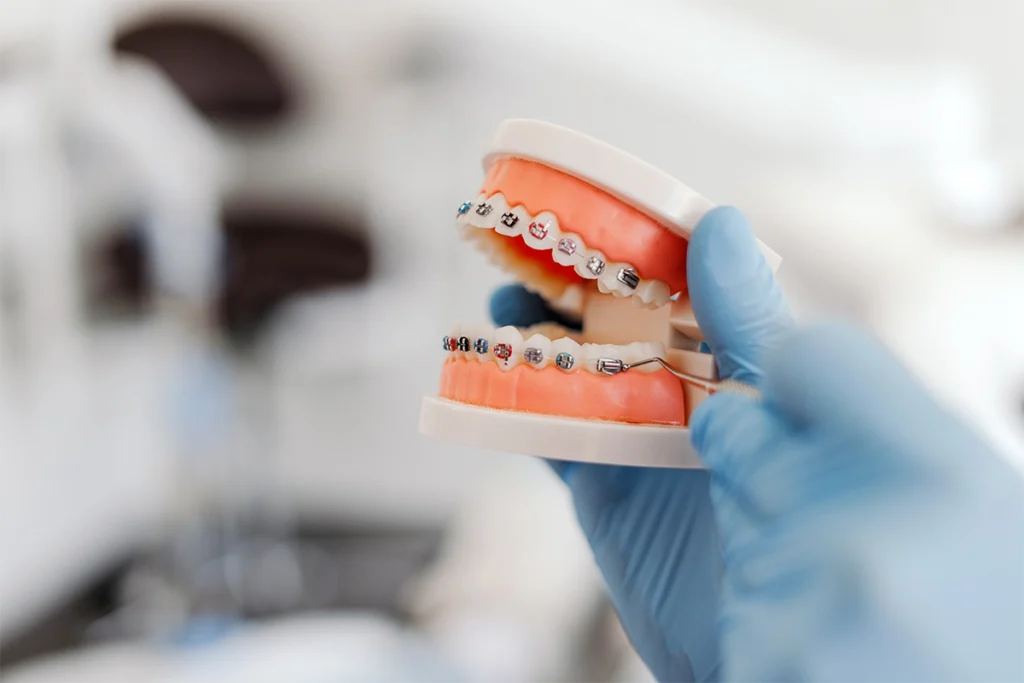 Modelo dental con brackets metálicos y estéticos que ilustra las opciones de ortodoncia de la clínica dental Gutiérrez Odontólogos en Almería