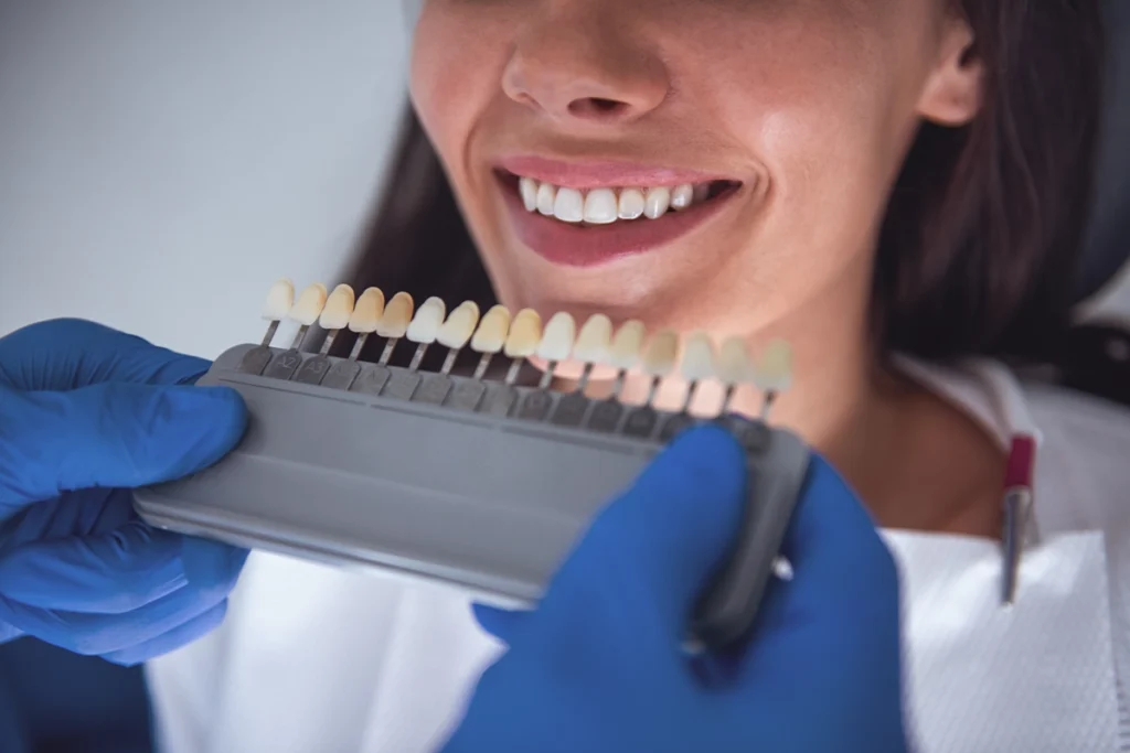 Dentista en Almería compara tonos con guía de color para colocar carillas dentales de composite en la clínica Gutiérrez Odontólogos