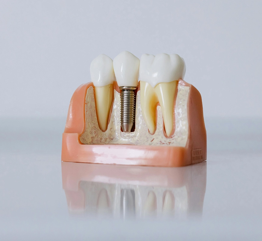 Modelo anatómico que muestra un implante dental entre piezas naturales, ilustrando los tratamientos de implantología de la clínica dental Gutiérrez Odontólogos en Almería