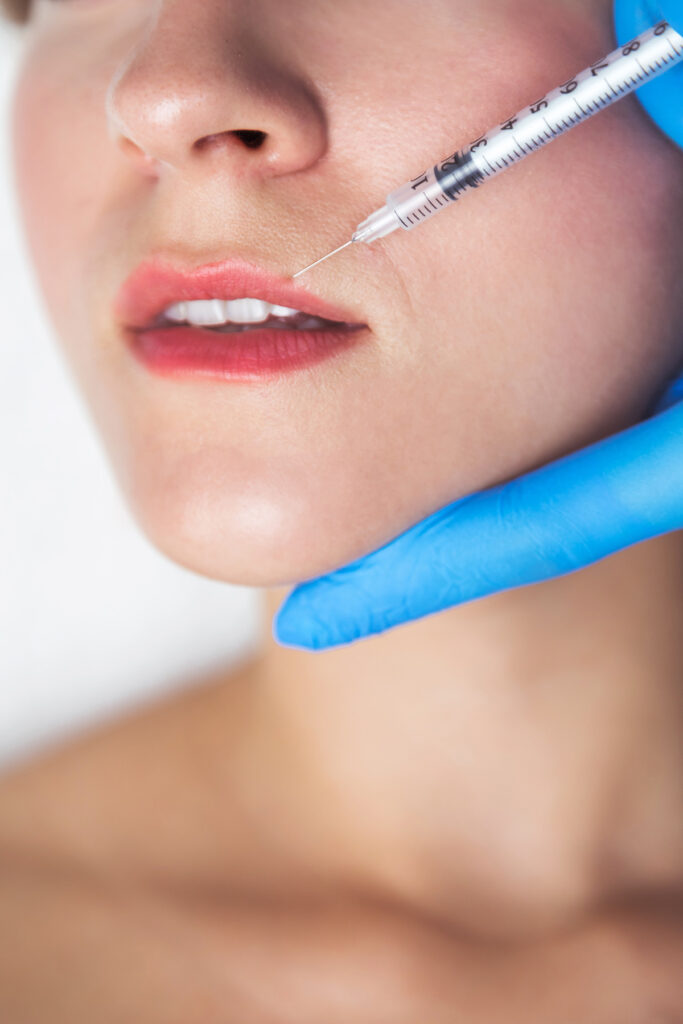 Remodelación labial con ácido hialurónico realizada por dentista recomendado en Almería de la clínica dental Gutiérrez Odontólogos