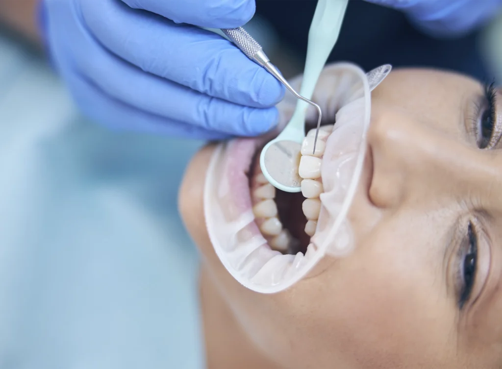 Dentista en Almería mide la profundidad de las encías durante una revisión periodontal en la clínica dental Gutiérrez Odontólogos