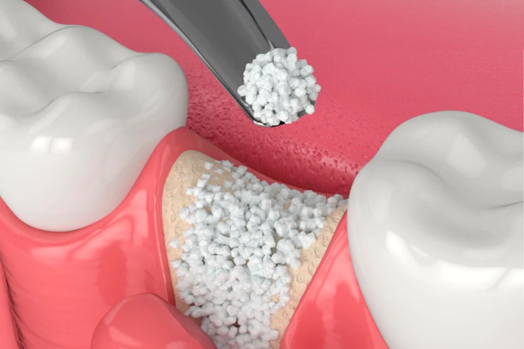 IMPLANTES DENTALES SIN HUESO