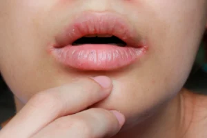 QUELITIS ANGULAR CAUSAS EFECTOS Y TRATAMIENTO - Gutiérrez Odontólogos es tu clínica dental en Almería, Av. Ntra. Señora de Montserrat 20, con más de 30 años cuidando la salud bucodental local. El Dr. Antonio Gutiérrez y su equipo familiar combinan experiencia y formación continua para ofrecer implantes dentales, periodoncia, ortodoncia, estética dental y medicina estética facial en un entorno seguro y digital. Empleamos radiodiagnóstico 3D, técnicas sin dolor y materiales certificados, diseñando planes personalizados que mejoran función y estética. Rigor, innovación y trato cercano nos convierten en referencia para sonrisas sanas y duraderas en Almería y alrededores. QUELITIS ANGULAR CAUSAS EFECTOS Y TRATAMIENTO