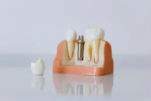 implante dental - Gutiérrez Odontólogos es tu clínica dental en Almería, Av. Ntra. Señora de Montserrat 20, con más de 30 años cuidando la salud bucodental local. El Dr. Antonio Gutiérrez y su equipo familiar combinan experiencia y formación continua para ofrecer implantes dentales, periodoncia, ortodoncia, estética dental y medicina estética facial en un entorno seguro y digital. Empleamos radiodiagnóstico 3D, técnicas sin dolor y materiales certificados, diseñando planes personalizados que mejoran función y estética. Rigor, innovación y trato cercano nos convierten en referencia para sonrisas sanas y duraderas en Almería y alrededores. implante dental