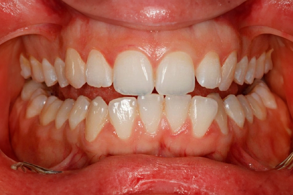 problemas oclusion dental